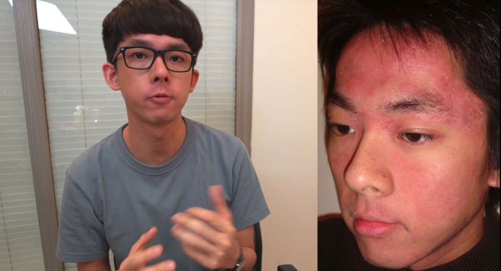 異位性皮膚炎