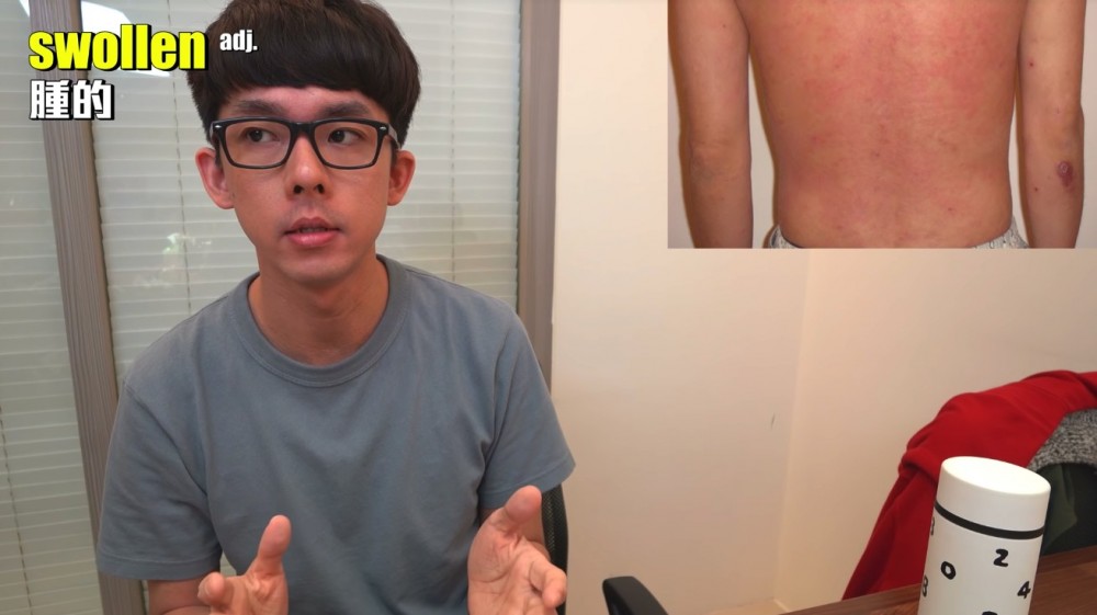 異位性皮膚炎