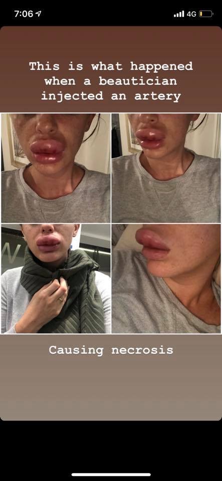 botox