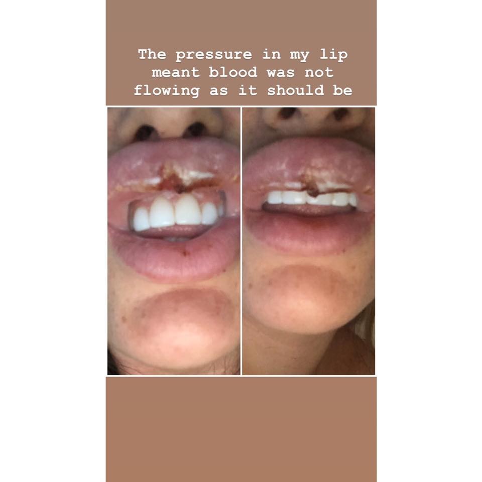 botox