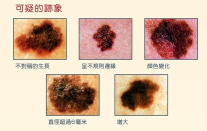 皮膚癌 黑色痣或演變成惡性皮膚腫瘤亞洲人病變位置多在腳底手掌 Urbanlife 健康新態度