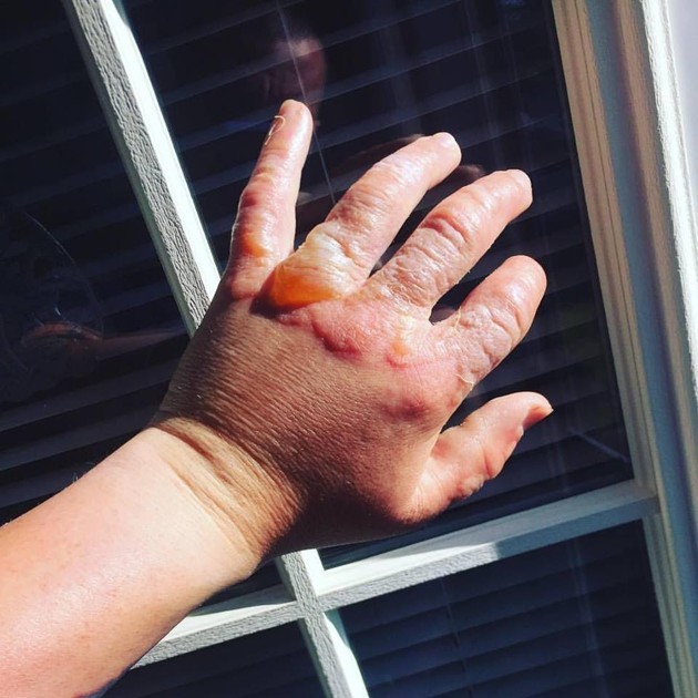 【檸檬惹的禍】陽光下搾檸檬汁 婦女被二級燒傷 雙手紅腫佈滿水泡