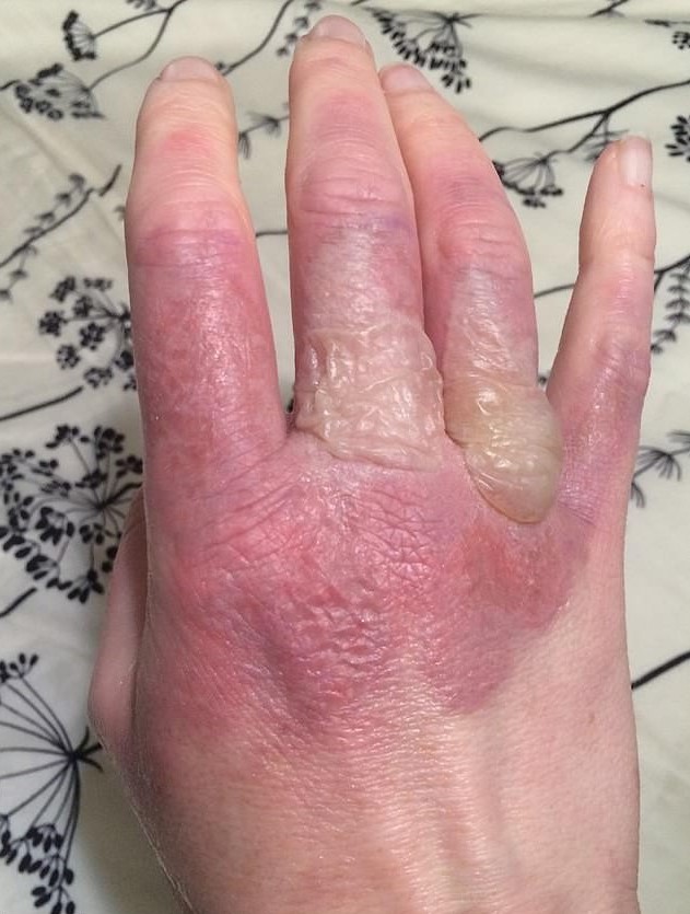 【檸檬惹的禍】陽光下搾檸檬汁 婦女被二級燒傷 雙手紅腫佈滿水泡