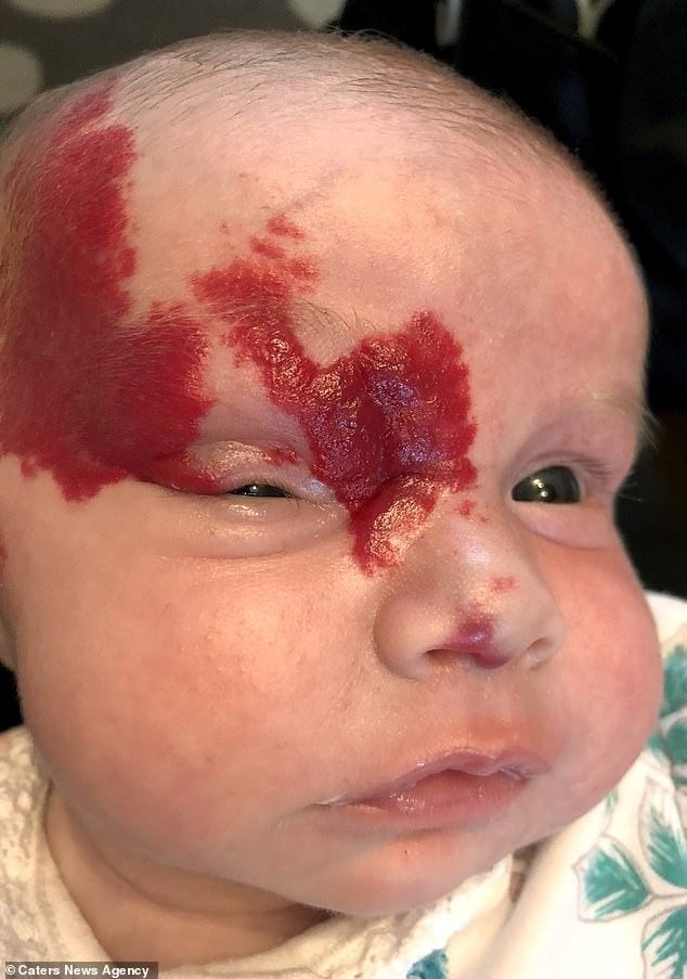 【愛的記號】醫生誤診血管瘤為胎記 女嬰臉上鮮紅印記險致盲