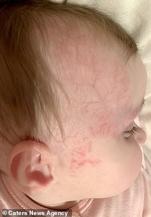 【愛的記號】醫生誤診血管瘤為胎記 女嬰臉上鮮紅印記險致盲