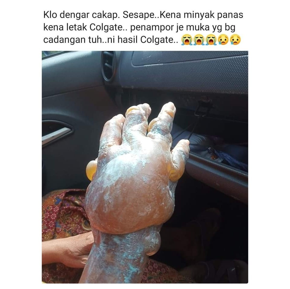 【民間偏方】以牙膏塗在燙傷處 患者手部嚴重感染出現巨型水泡