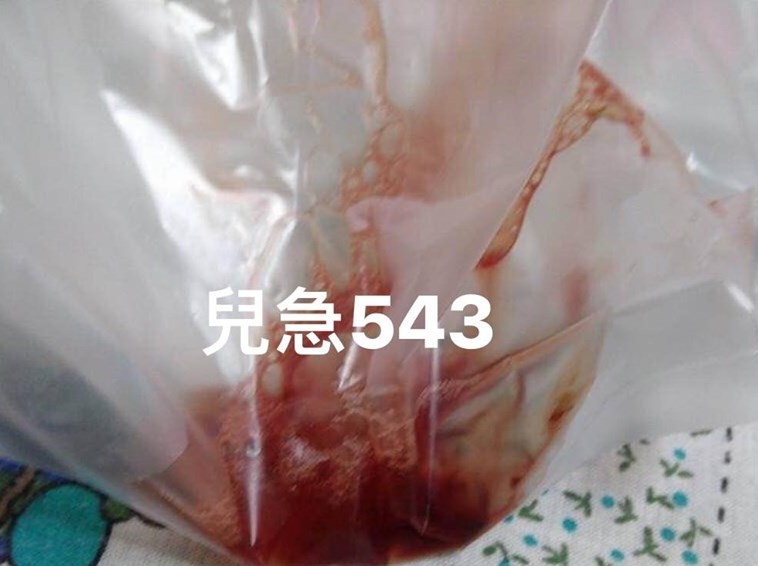 【 端午節注意】鹼水粽變毒藥 誤服鹼水 5歲孩童食道嚴重灼傷 吐出鮮血