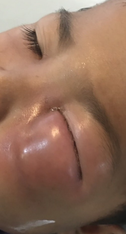 【愛糖如痴】3歲男童愛吃糖 牙齒幾乎蛀光 細菌上眼險失明