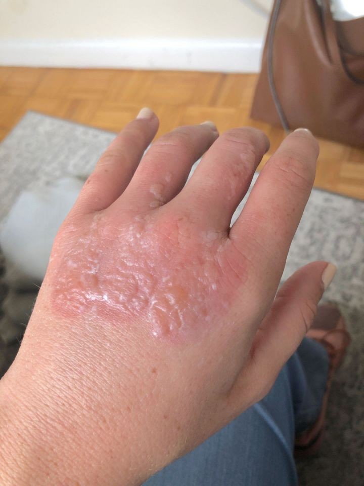 【檸檬惹的禍】陽光下搾檸檬汁 婦女被二級燒傷 雙手紅腫佈滿水泡