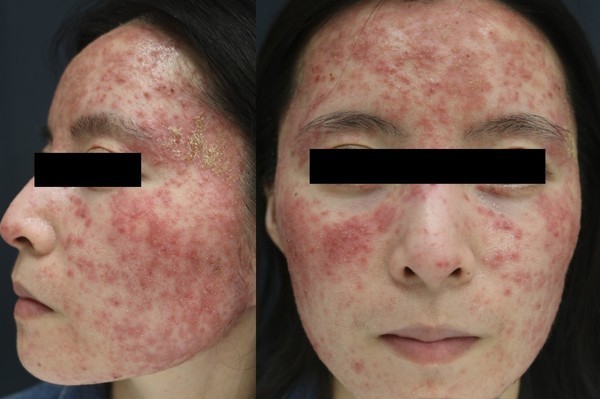 【皮膚病】女子臉部泛紅痕癢逾6年 求醫後揭發皮膚藏過萬隻蟎蟲