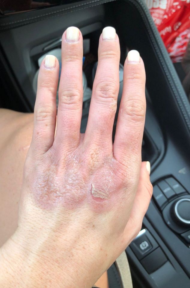 【檸檬惹的禍】陽光下搾檸檬汁 婦女被二級燒傷 雙手紅腫佈滿水泡