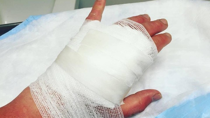 【檸檬惹的禍】陽光下搾檸檬汁 婦女被二級燒傷 雙手紅腫佈滿水泡