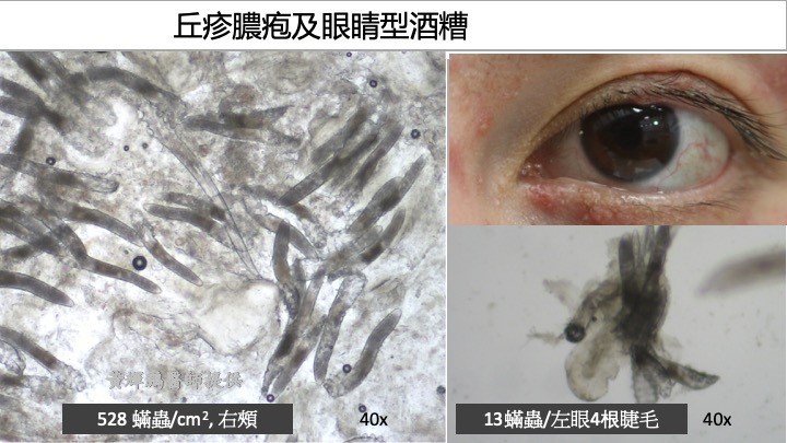 【皮膚病】女子臉部泛紅痕癢逾6年 求醫後揭發皮膚藏過萬隻蟎蟲