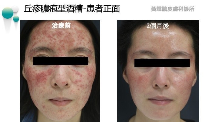 【皮膚病】女子臉部泛紅痕癢逾6年 求醫後揭發皮膚藏過萬隻蟎蟲