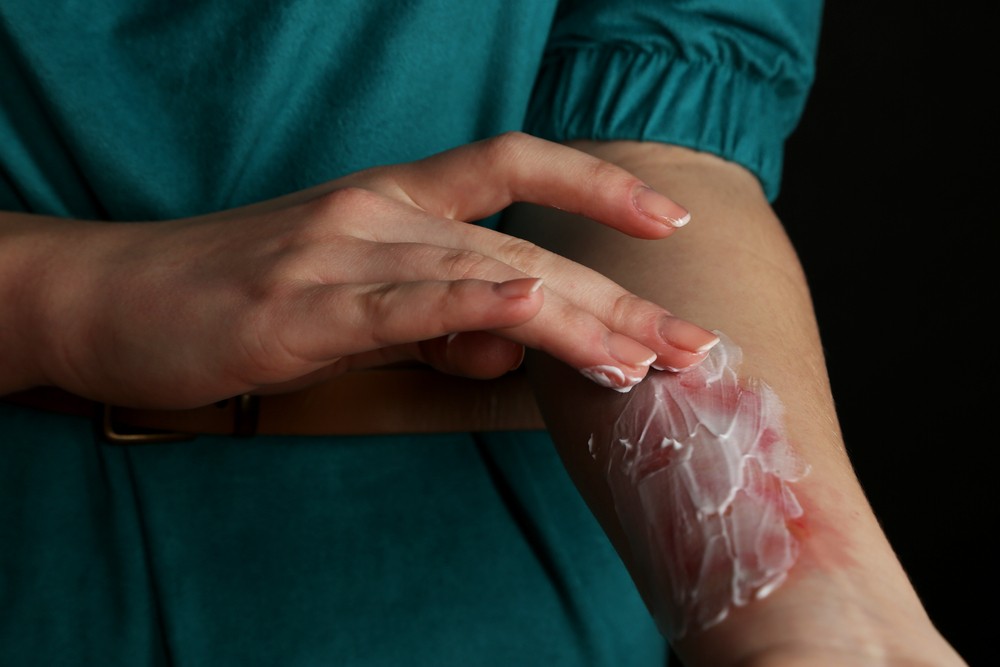 【民間偏方】以牙膏塗在燙傷處 患者手部嚴重感染出現巨型水泡