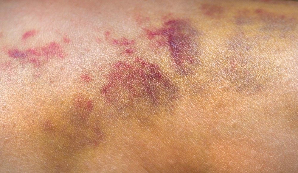 紅色為剛剛受傷的情況。