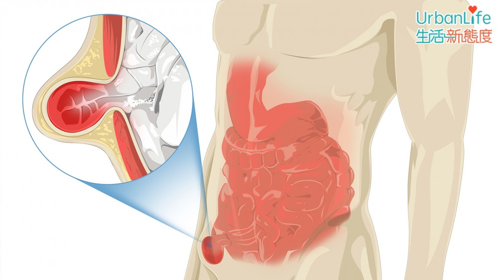 小腸氣可能出現嵌頓,當內臟跑出體外,時間太長出現水腫,無法縮回到腹腔內部。