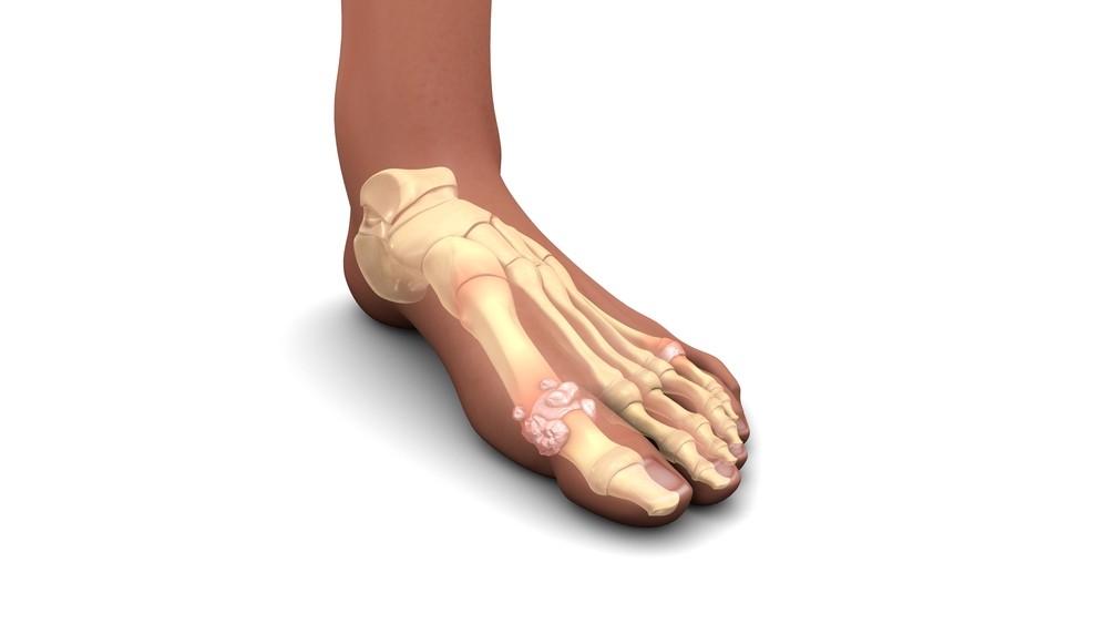 gout