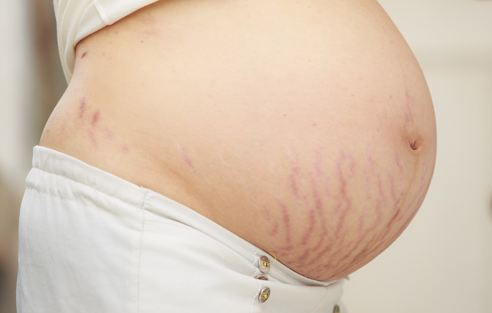 stretchmark