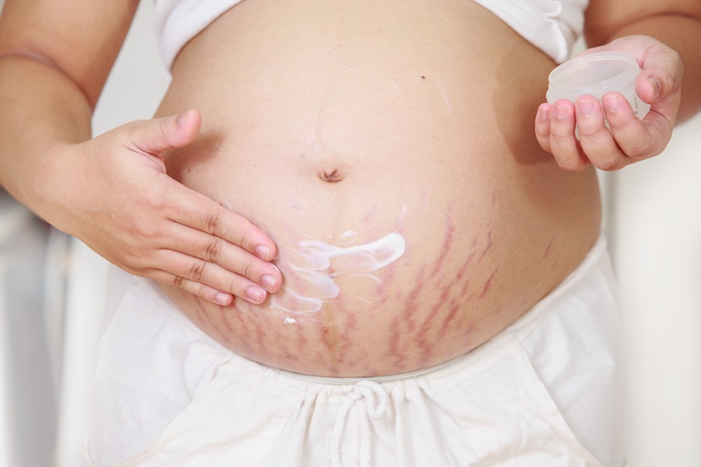 stretchmark