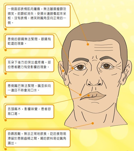 患者一般顏面肌肉無力,例如嘴角下垂、不能成功微笑和露齒等。