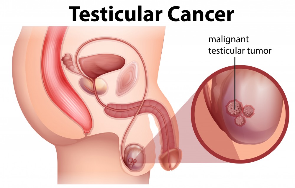 睾丸癌(testicular cancer)多發生在15至40歲的男性身上。