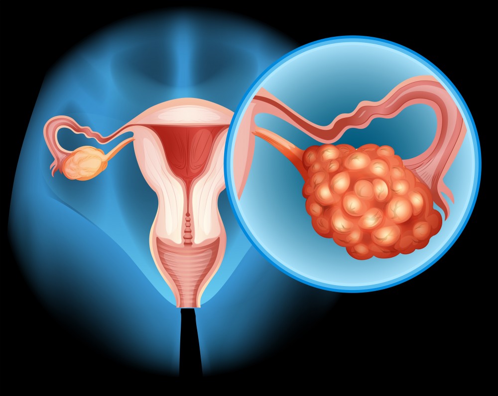 卵巢癌(Ovarian Cancer)是香港女性十大癌症中以發病率排行,佔第六位,每年新症約四百宗,大部分患者年齡超過五十歲。