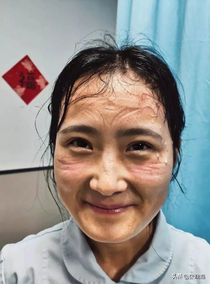 近日微博瘋傳一張女護士滿臉被防護罩勒過痕跡的相片,相中人的臉上雖流著一滴滴的汗水,但仍然保持甜美笑容。