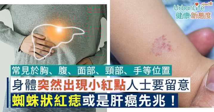 【紅痣原因】蜘蛛狀紅痣是肝癌先兆?身體突然出現小紅點人士要留意