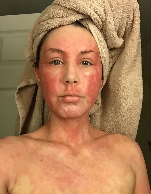 Louise的戒斷反應達至巔峰時,嚴重到皮膚腫脹、破裂、脫皮、發燒、虛弱無力,甚至無法閉眼。