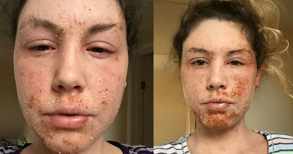 Louise表示隨著年齡漸長,濕疹的大爆發時間開始變得更加頻密,類固醇的使用劑量也越來越強,副作用越來越大。