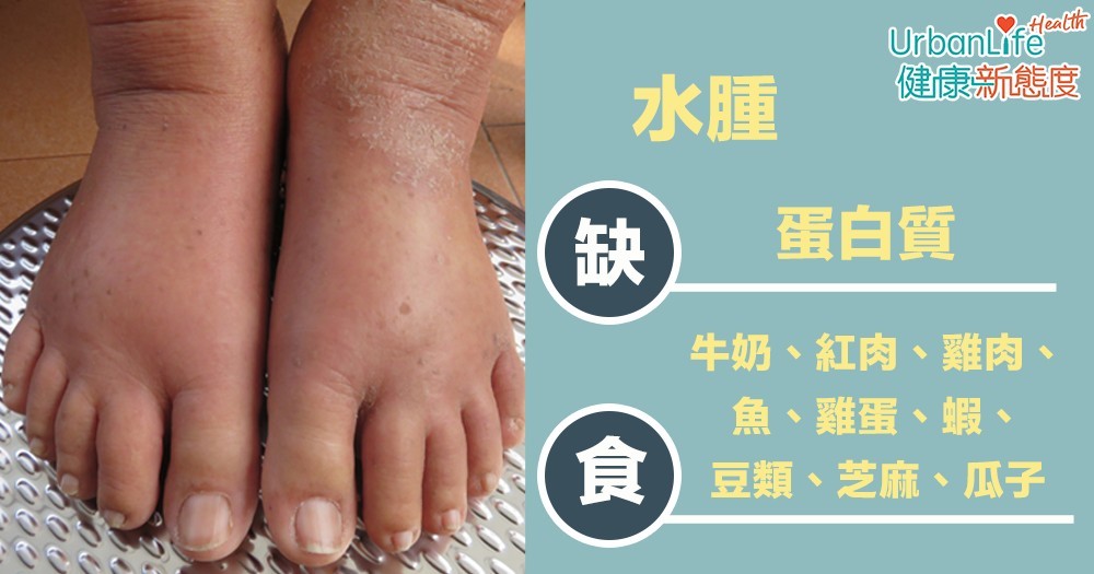 水腫