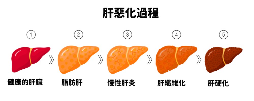 健康的肝要惡化到肝硬化需要10到20年的時間,所以罹患肝癌並非偶然。