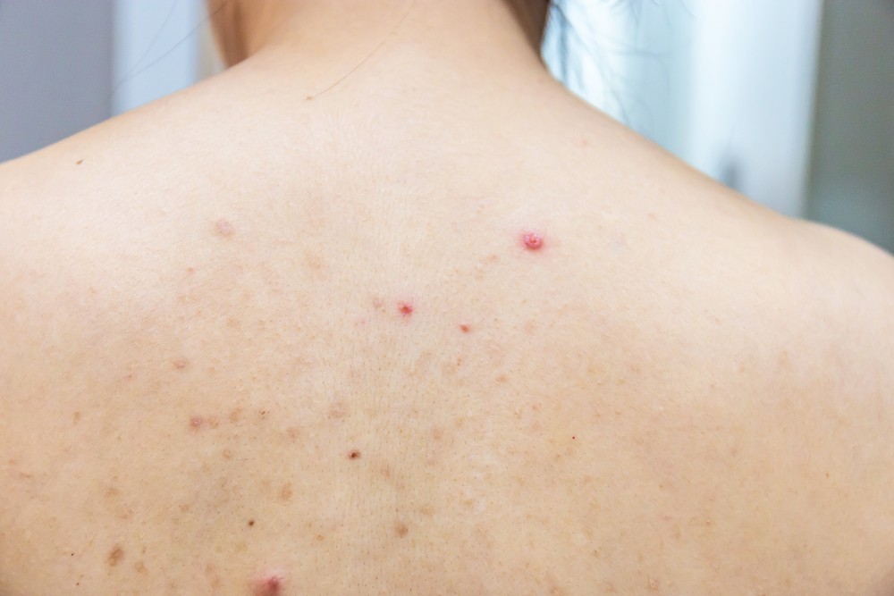 近日天氣逐漸回暖,皮膚油脂分泌開始旺盛,大大增加長出暗瘡的機會。