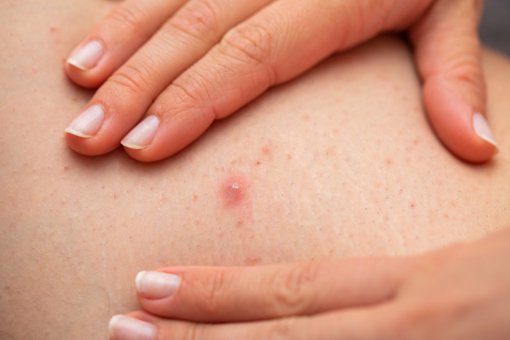 毛囊炎是一種普遍的皮膚問題，顧名思義就是毛囊發炎，可由汗水、細菌、真菌等許多原因引發。