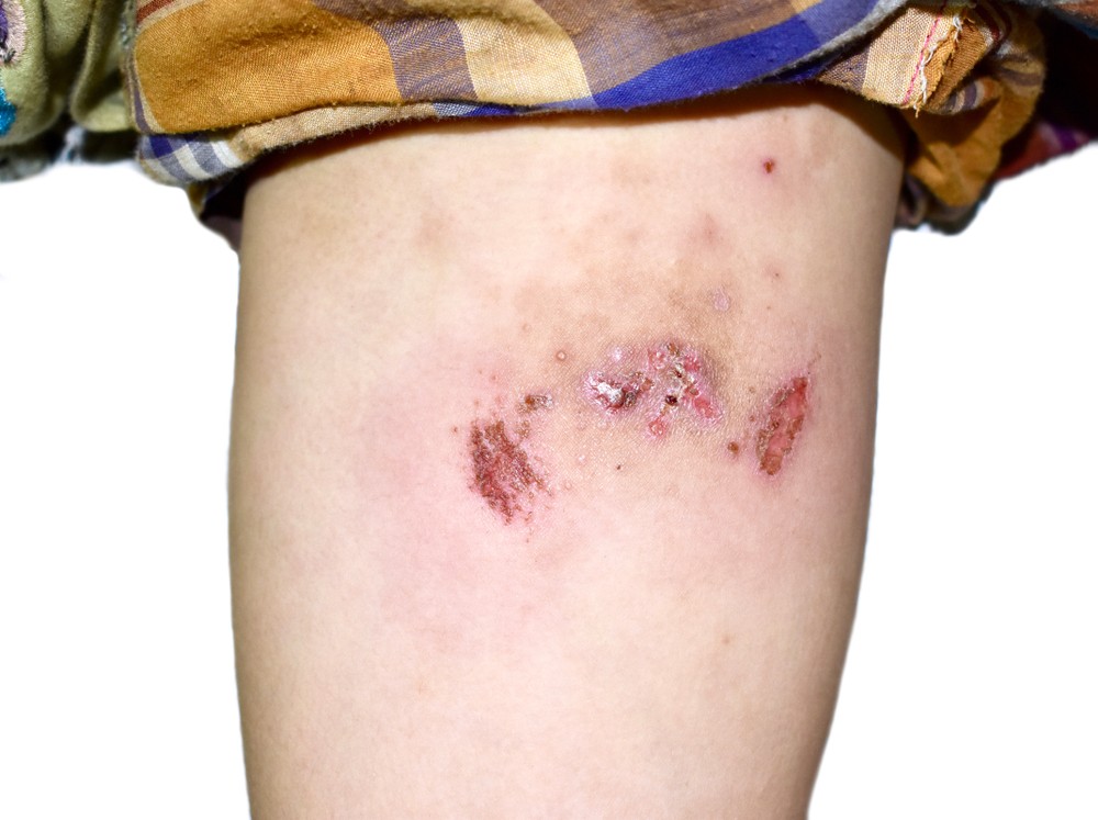 金黃葡萄球菌是一種常見於皮膚及呼吸道（鼻子、口腔、喉嚨、肺）的細菌，能夠入侵傷口或免疫力弱的人士，繼而造成感染。