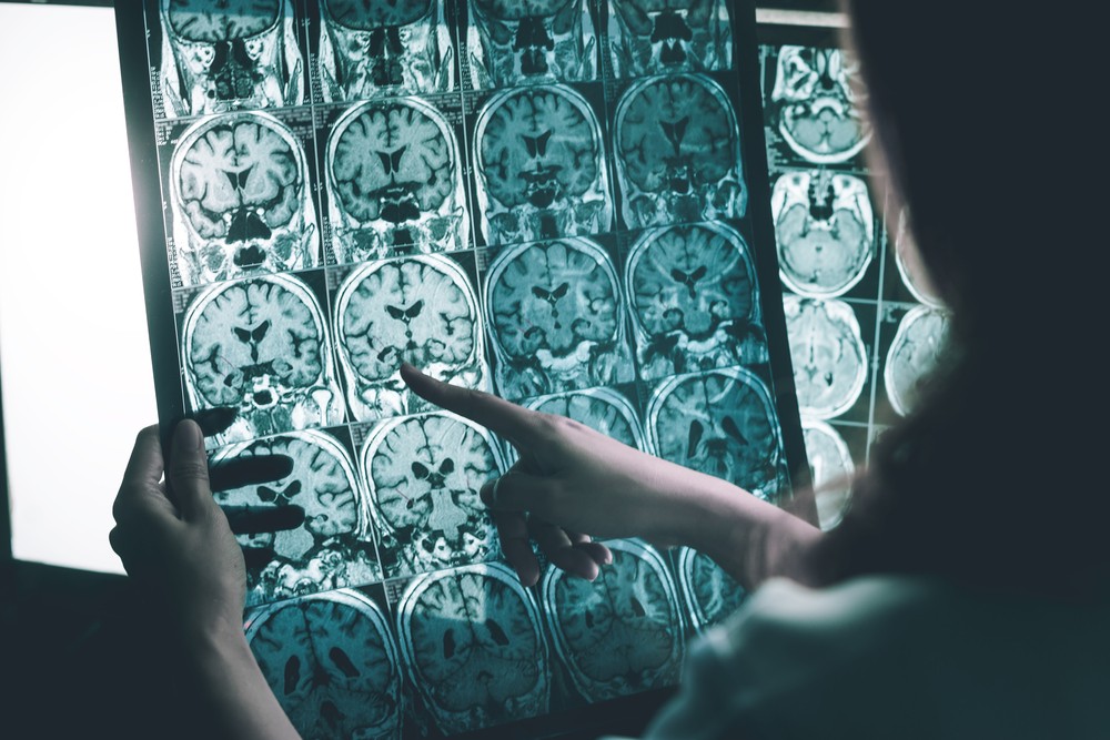 磁共振成像(MRI)是其中一個檢測是否患有老年癡呆症的檢測方法之一。
