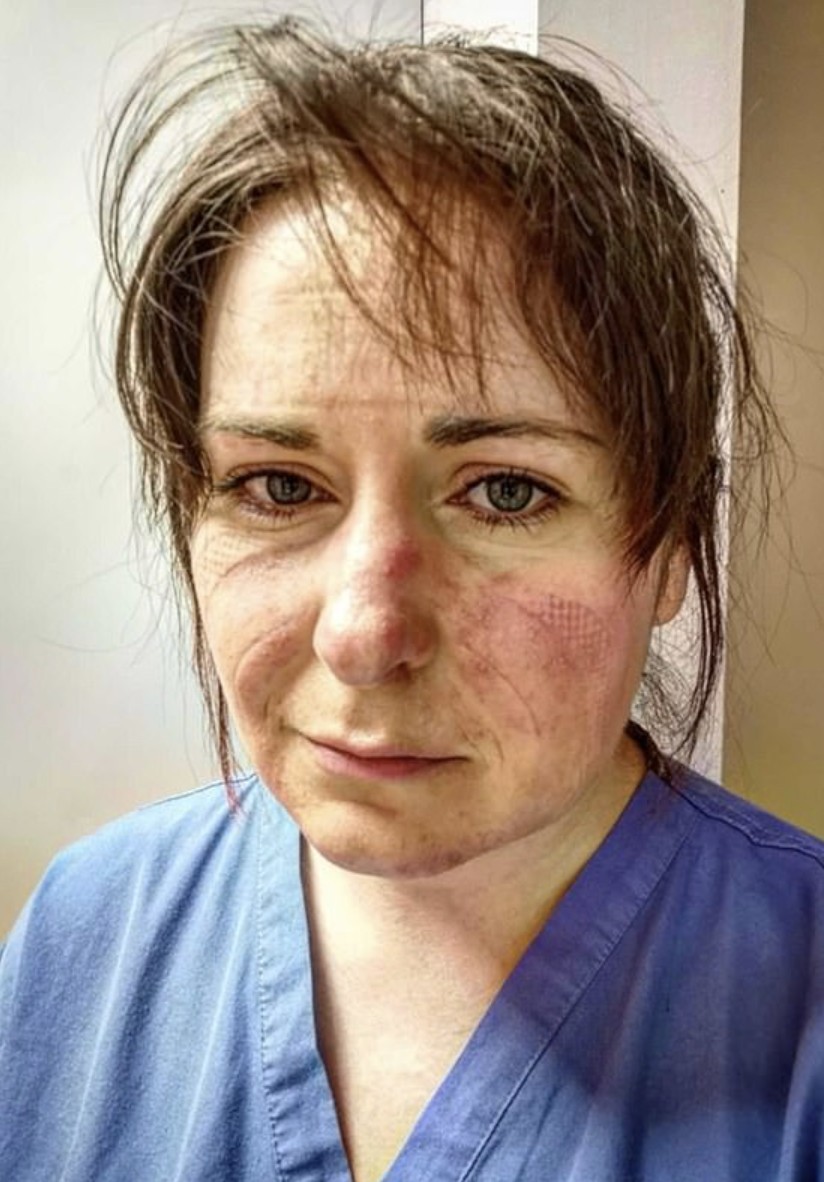 新型肺炎疫情持續。一名英國護士於社交平台分享一張她當值了13小時後除下防護裝備的照片,相片中可見她神色疲倦,整張臉都充滿了紅紅的勒痕。她在帖文中表示,希望人們可以記住她這張臉,遵守防疫措施,留家抗疫。