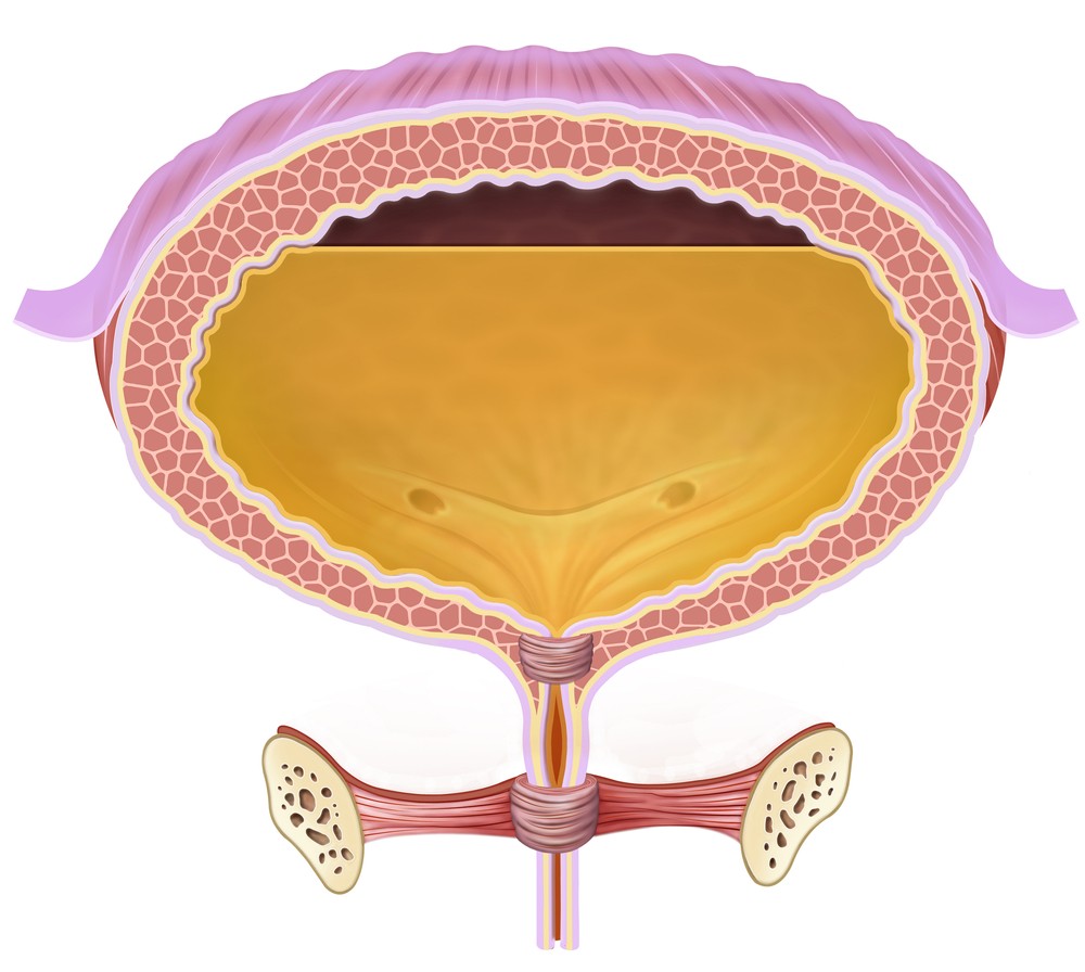 美國匹茲堡大學醫學中心最近從一名糖尿病婦身上發現罕見病例,該名婦人的膀胱含有一種類似釀酒酵母的特殊菌種,能夠「釀造」酒精。