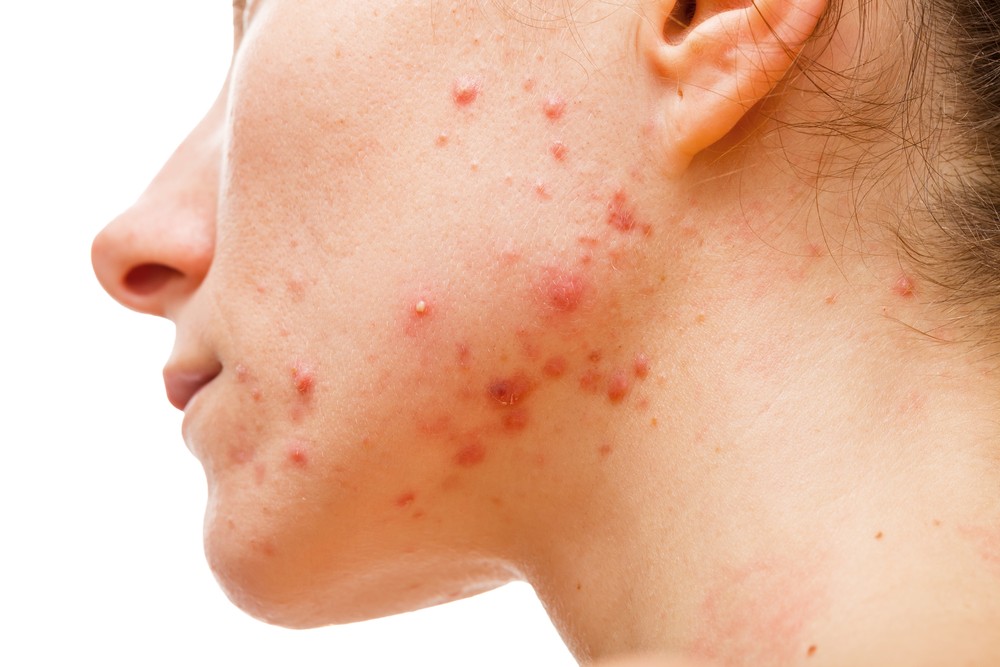 丘疹型暗瘡(Papule Acne)是·青少年比較常見的暗瘡類型。