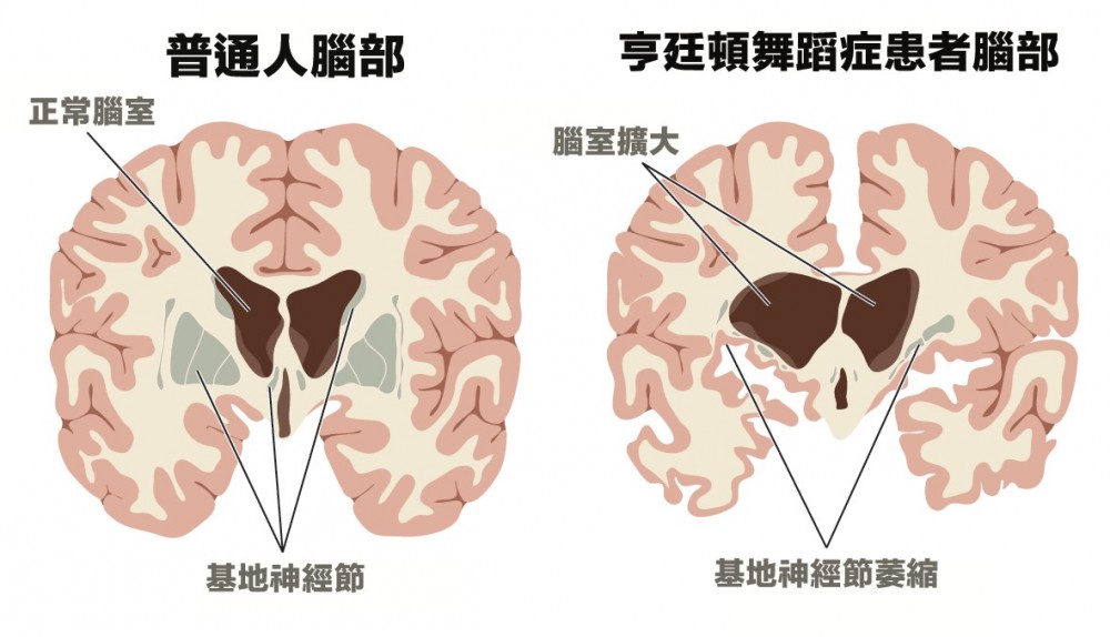 正常人和亨廷頓症患者的腦部對比。