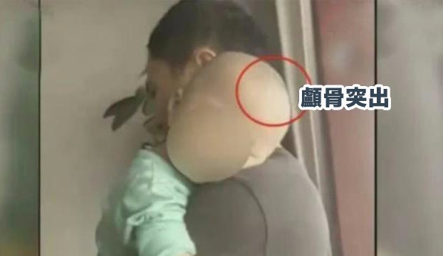 家長發現自己孩子身體出現濕疹、體重嚴重下降、顱骨突出畸形猶如「大頭娃娃」等症狀。