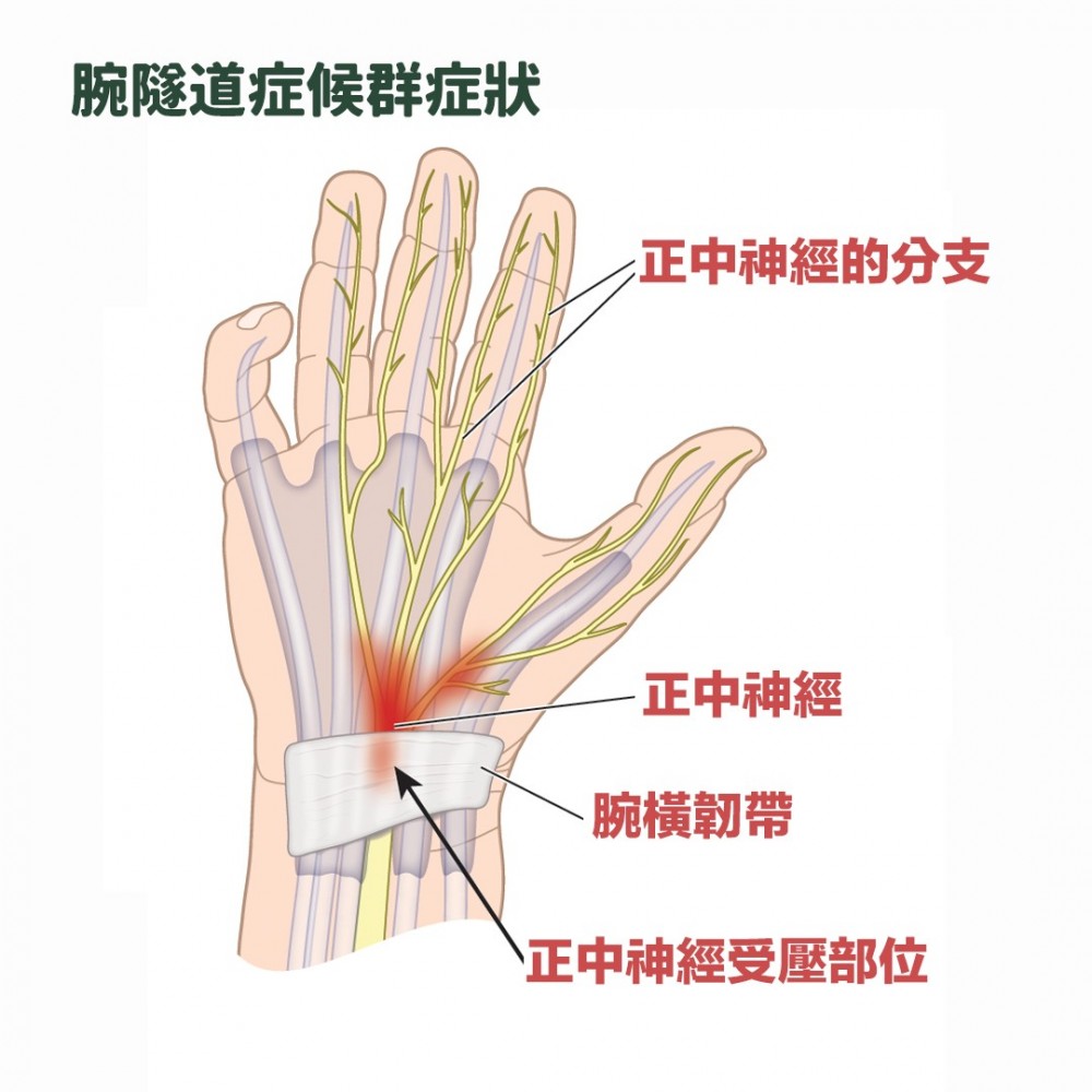 控管大拇指、食指、中指及一部分無名指的正中神經,當遭受外來壓迫時,會有酸痛、痲痹症狀。