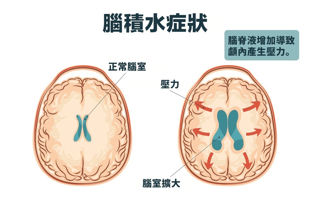通常是由於包圍著腦部與脊椎的腦脊液異常增加,導致顱內壓力異常增加所致。