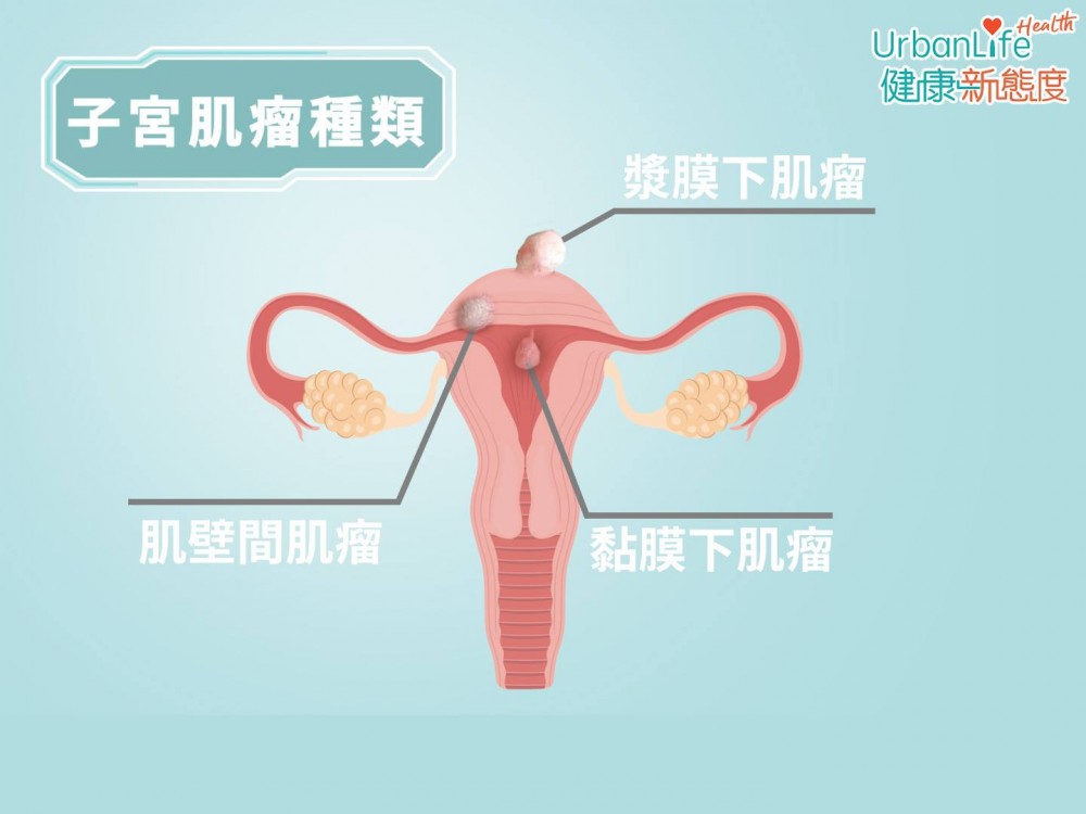 肌瘤可分為三大種類，包括：漿膜下肌瘤、黏膜下肌瘤、肌壁間肌瘤。