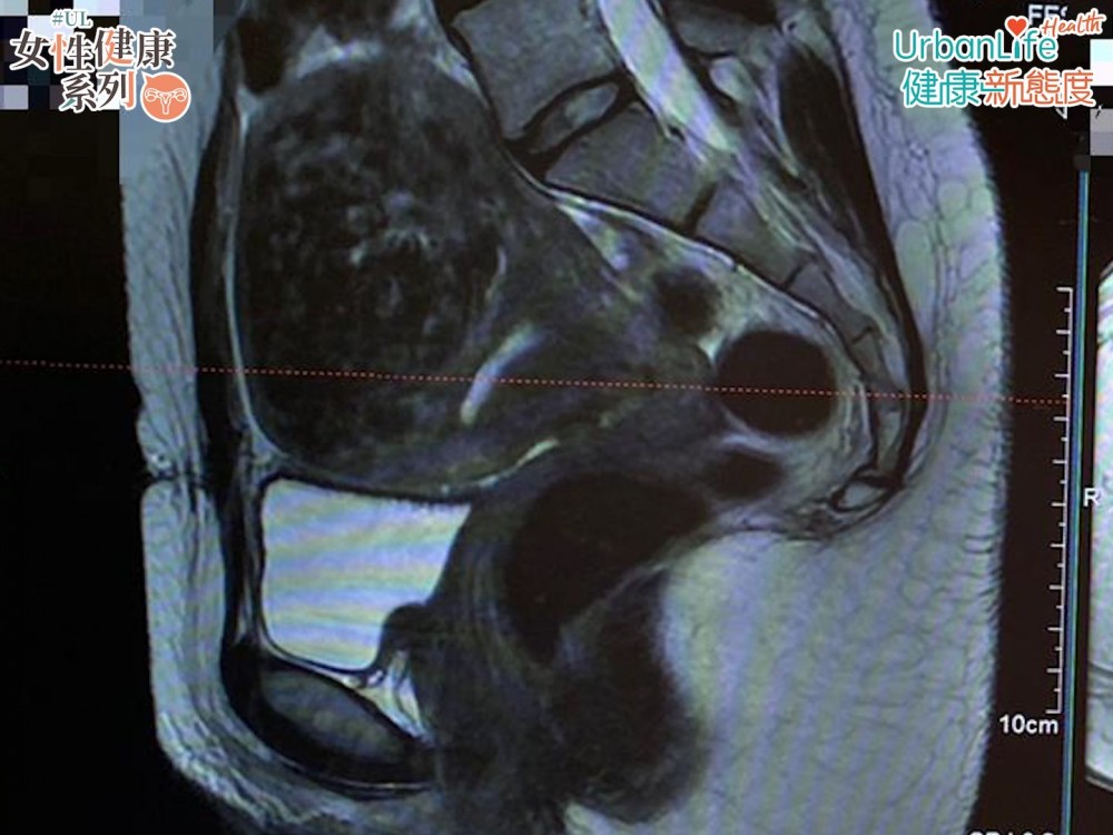 李醫生指，子宮肌瘤最小的可以只有1厘米以下，但最大可以有20多厘米。