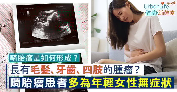【畸胎瘤】長有毛髮、牙齒、四肢的腫瘤? 畸胎瘤患者多為年輕女性無症狀