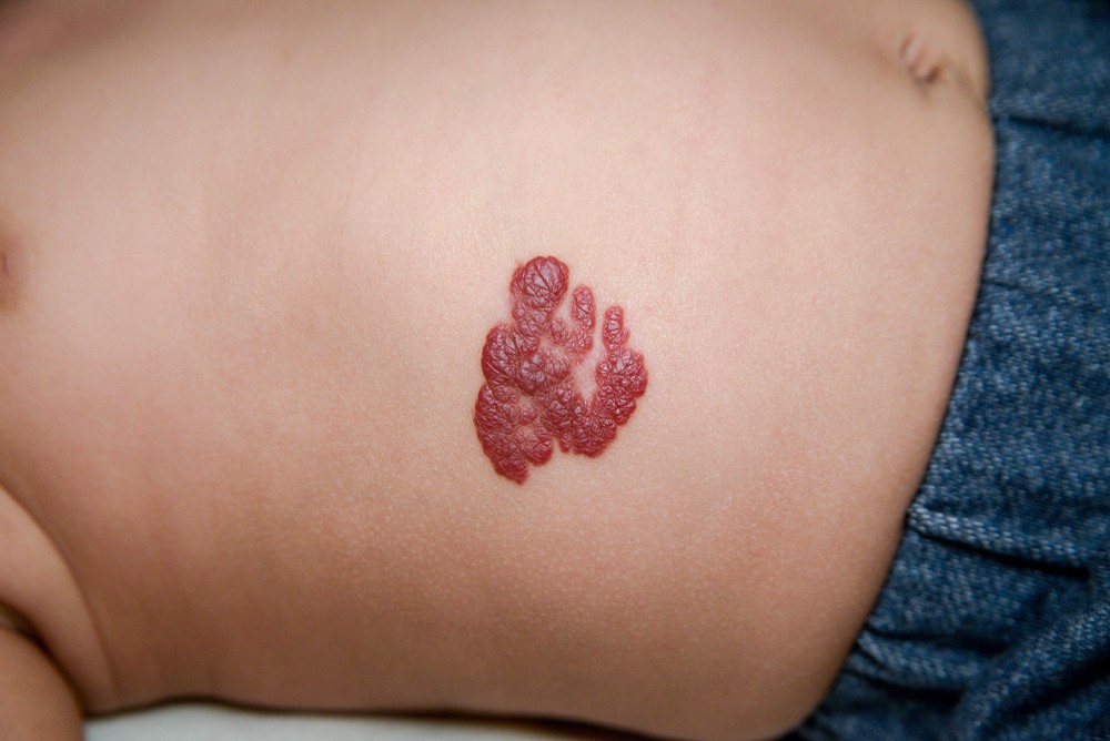 血管瘤雖然是良性的,但一些快速生長的血管瘤可能會壓迫到器官的功能,如脊柱、中樞神經系統、循環系統或致盲等。