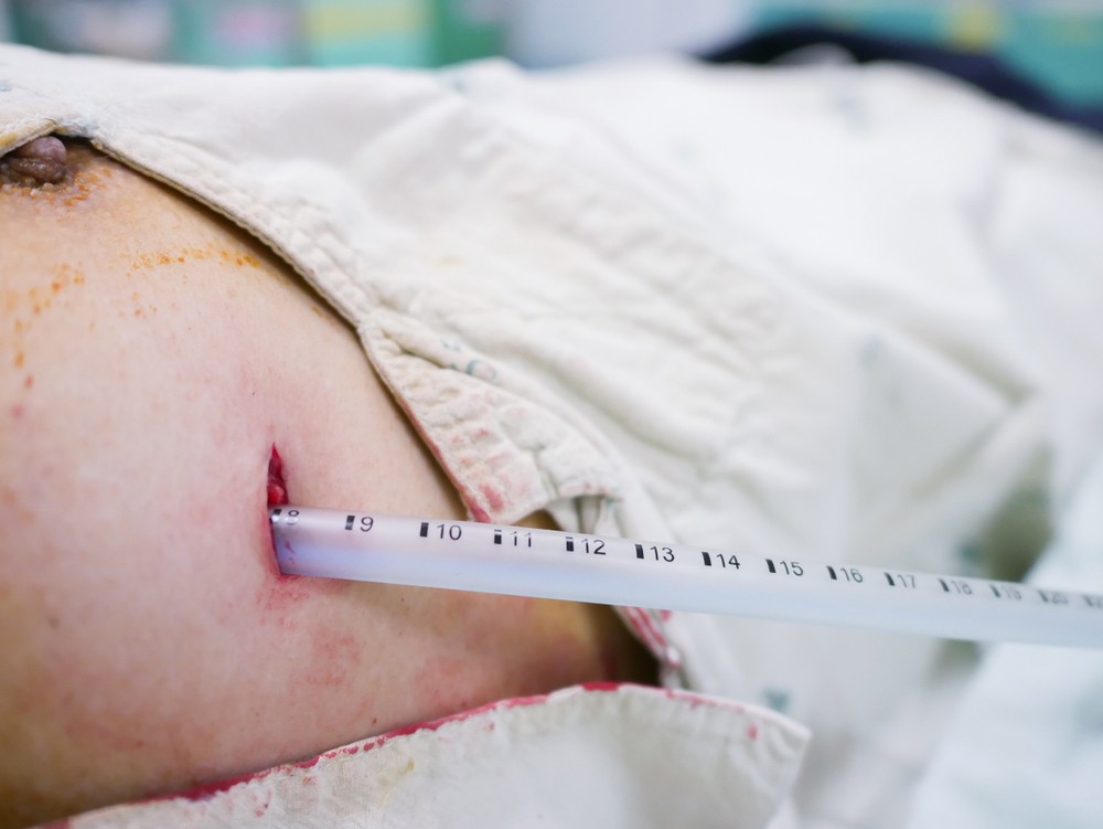 初次發生的氣胸通常採用胸腔閉式引流治療，利用針筒或導管抽出胸膜腔內的空氣。