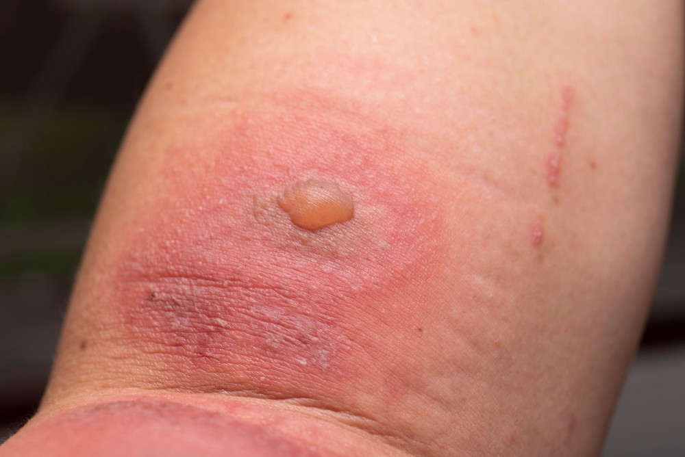 被隱翅蟲毒液濺到，傷口會迅速發炎、潰爛、生水泡。